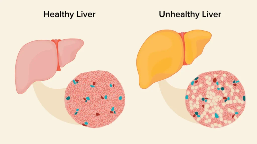 Ayurvedic remedies for fatty liver image