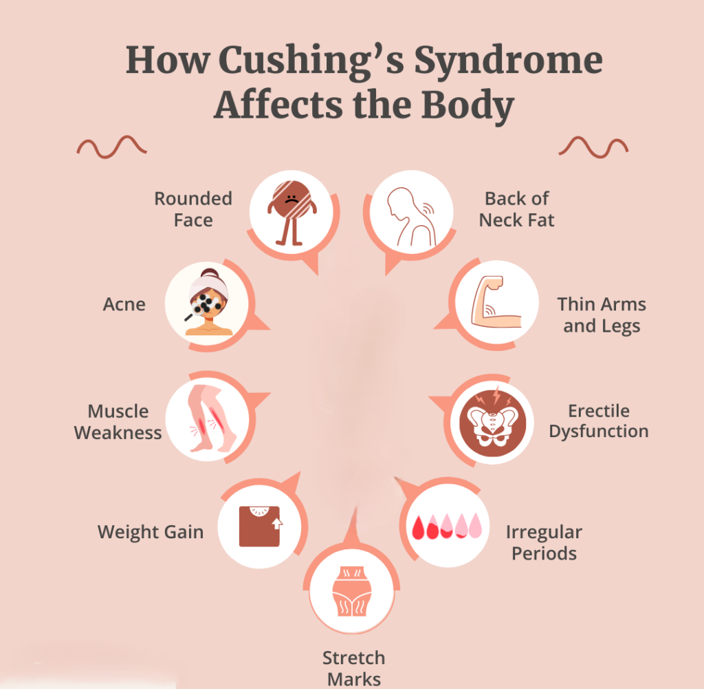 Cushing syndrome 