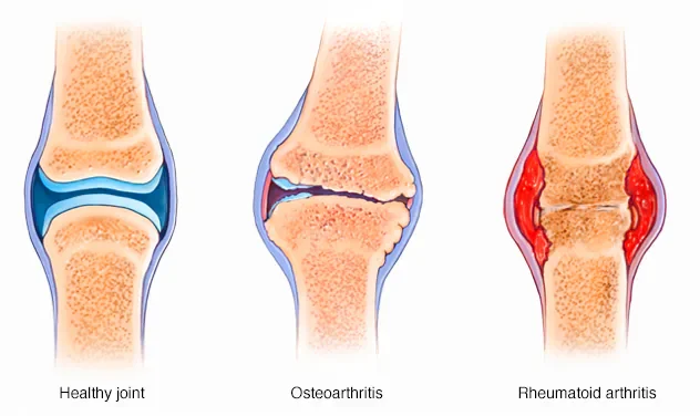 Arthritis in Ayurveda image