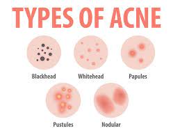 Ayurvedic Acne Remedies | image